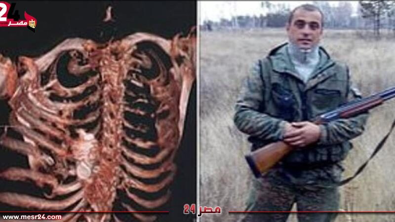 البوكس نيوز – بالصور.. إزالة قنبلة يدوية من صدر جندي روسي قبل انفجارها